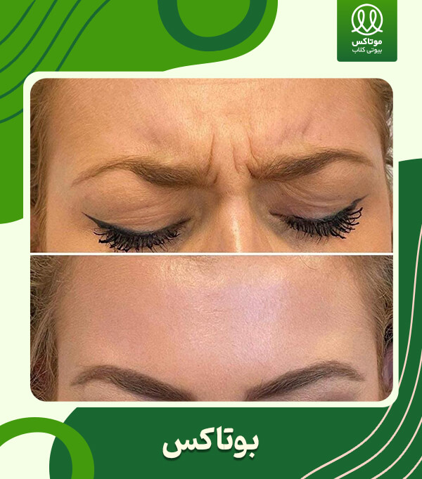 بوتاکس