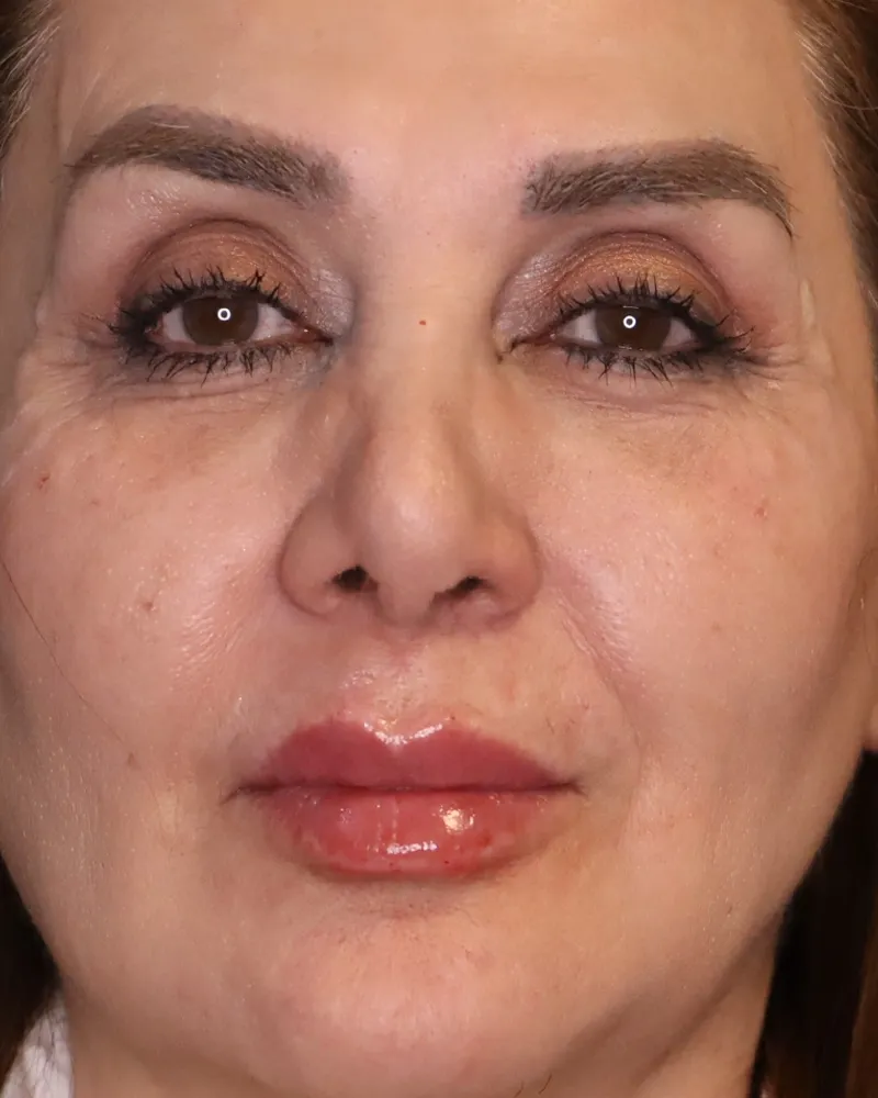 blepharoplasty after