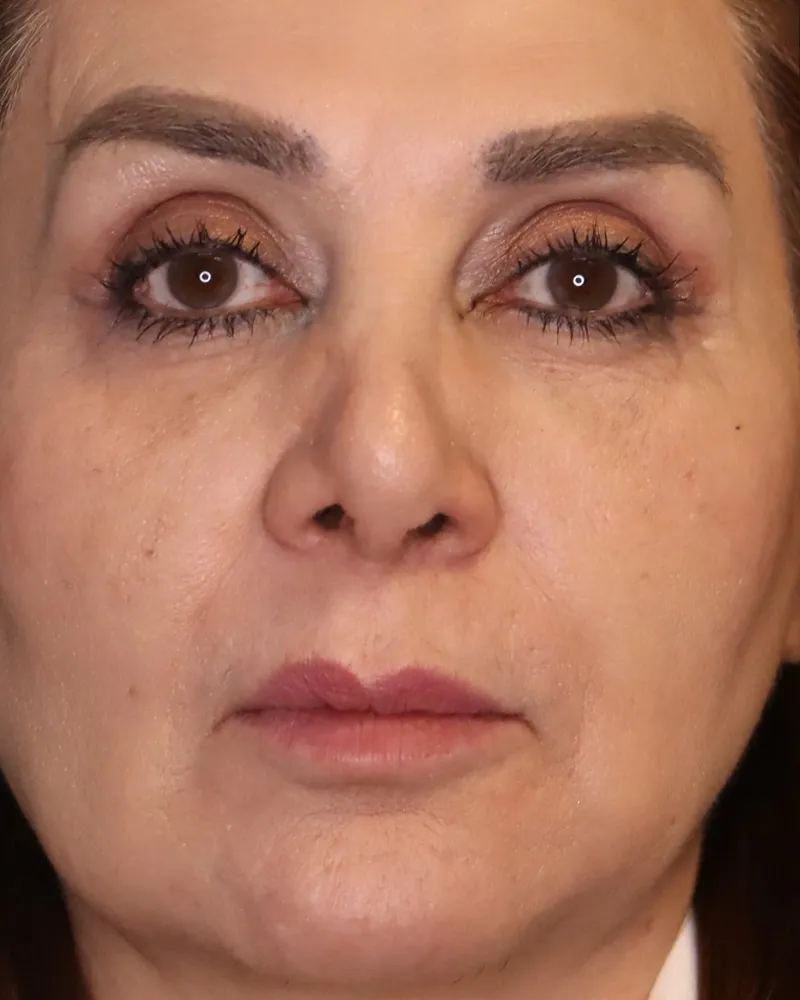 blepharoplasty before