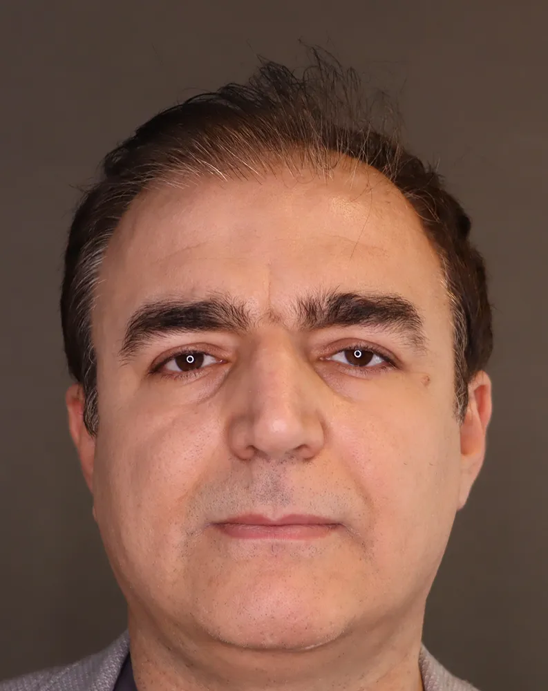 botox 1 after