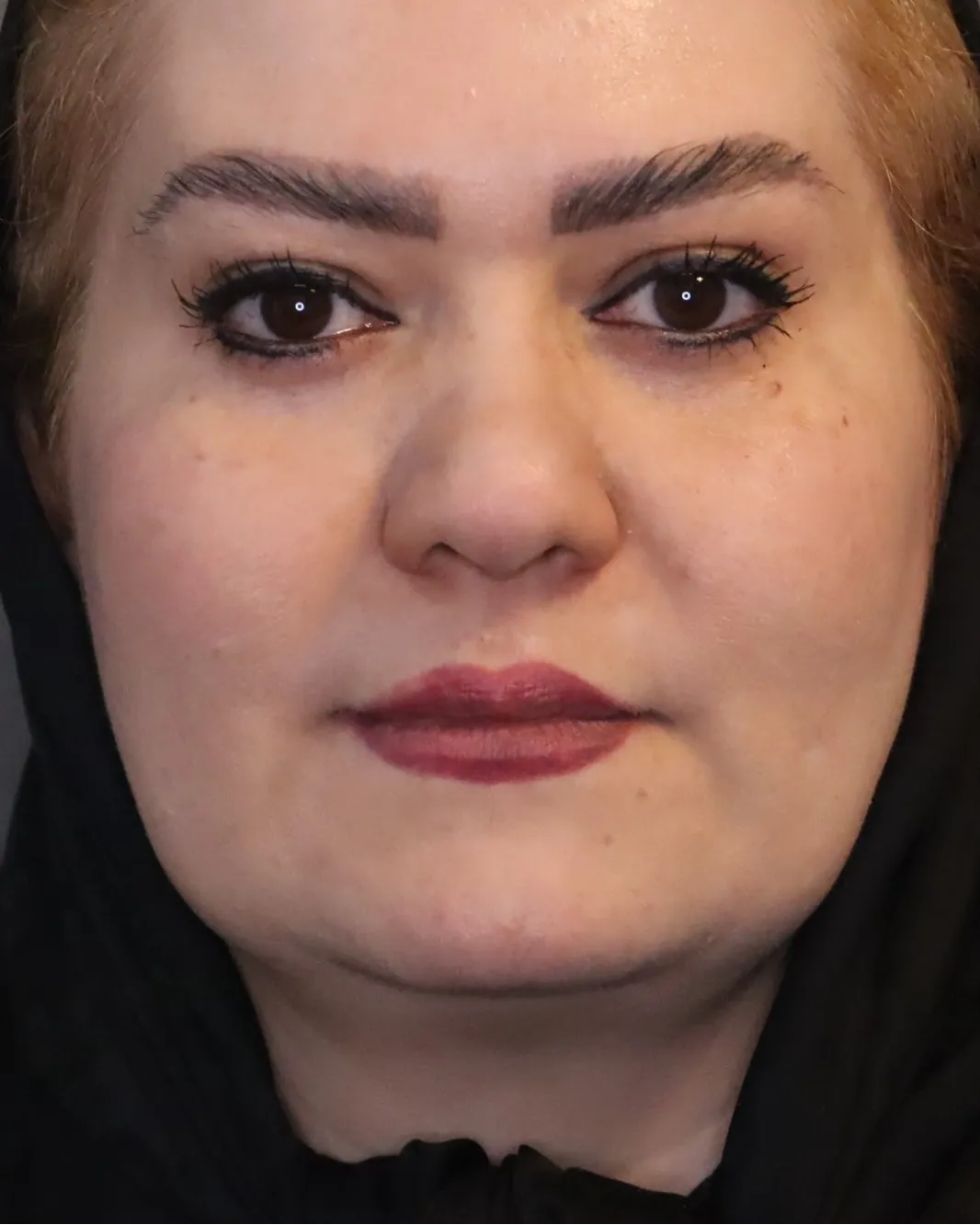 facial angulation after