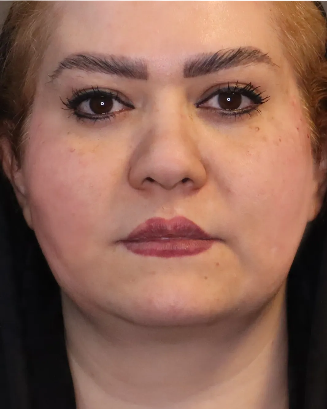 facial angulation before