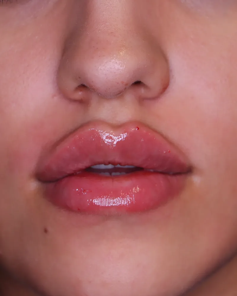 lip-filler 2 after