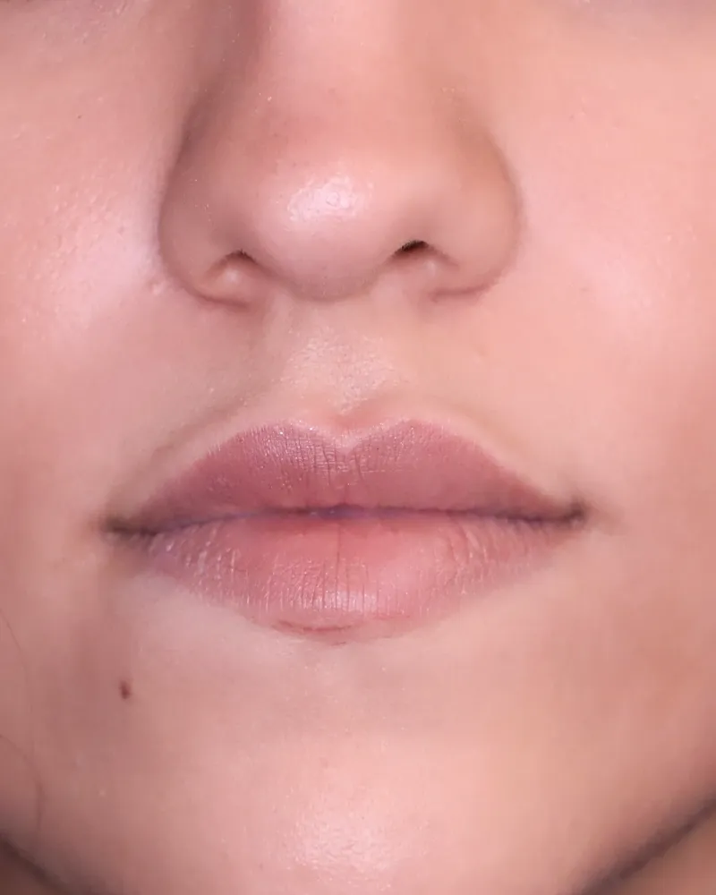 lip-filler 2 before