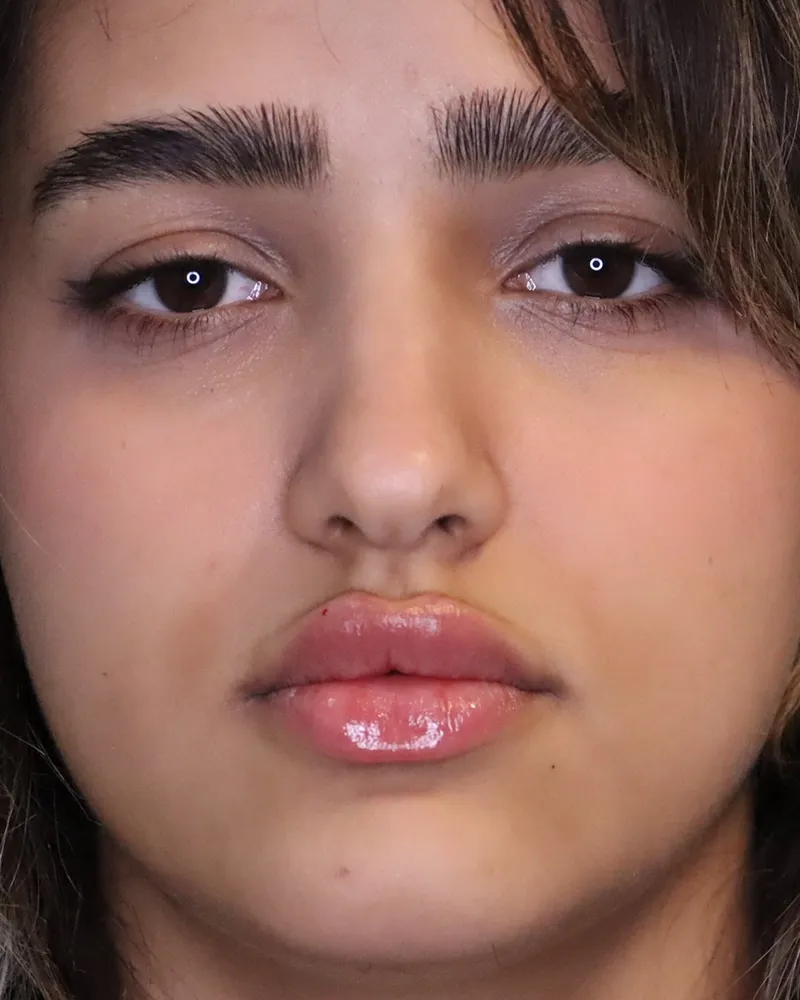 lip-filler 3 after