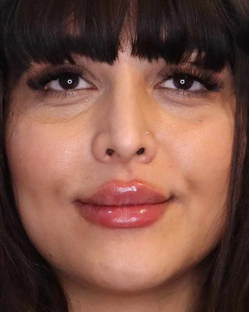 lip-filler 4 after