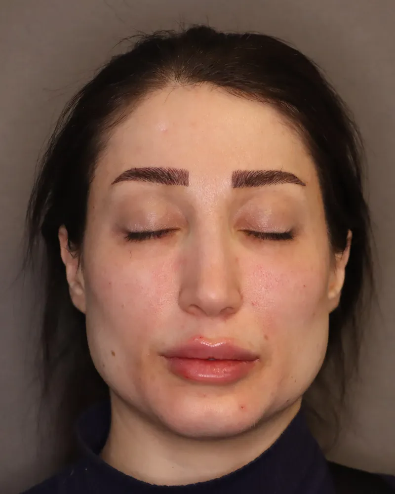 lip-filler 5 after