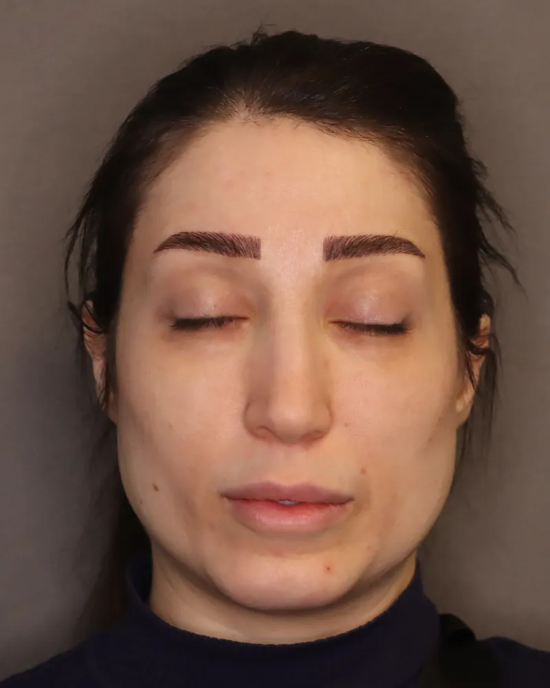 lip-filler 5 before