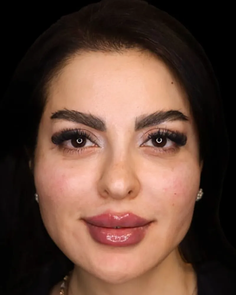 lip-filler 6 after
