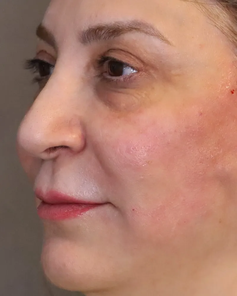 lip-filler after