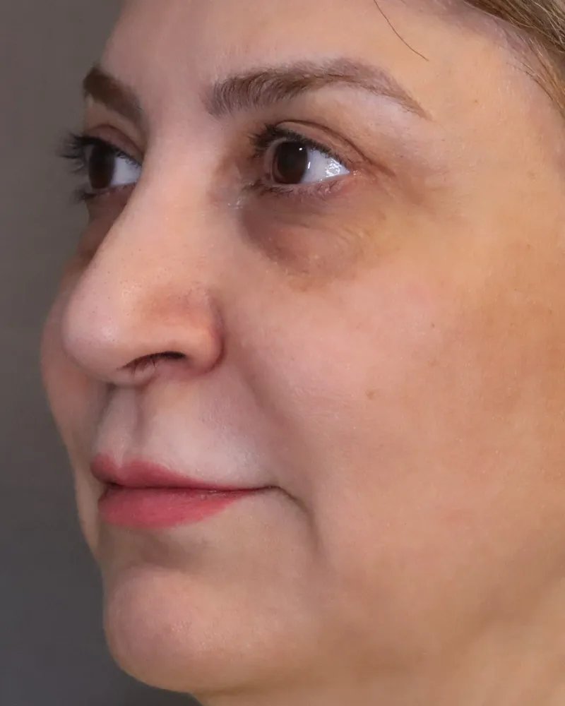 lip-filler before