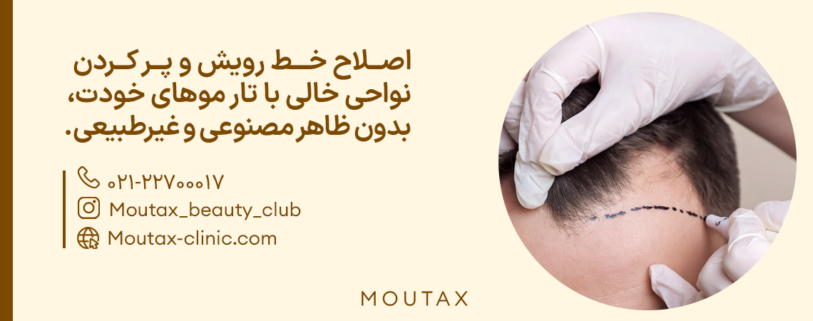 کاشت مو